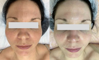 Авторский пилинг Ровный тон